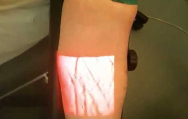Новый медицинский способ увидеть вены на руке человека